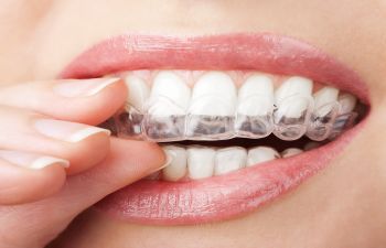 A woman putting a clear tray over her upper teeth.