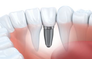 Implant model of dental implants available in Marietta GA