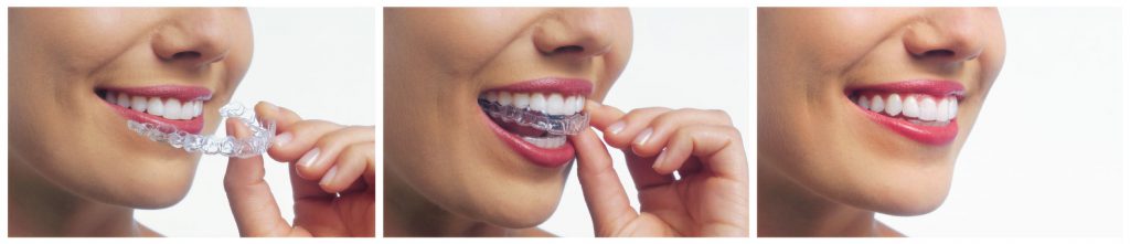 Woman's teeth during and after invisalign treatment.