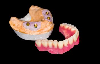 Implant-supported denture model