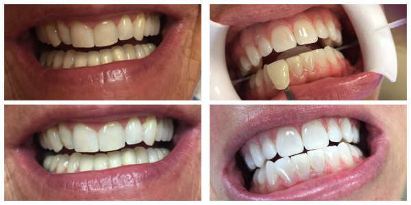 Patient's teeth before, during and and after teeth whitening treatment in Marietta GA.